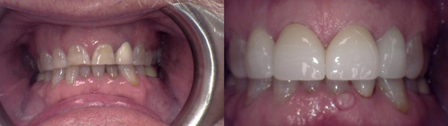 Anterior Dental Crowns upper before and after