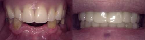 Old denture existing lower before and after
