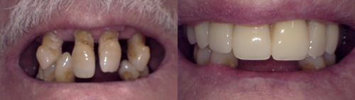 Before and after of upper Dentures