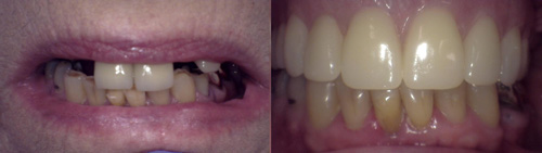 Upper dentures before and after comparison