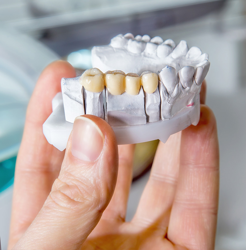 What Is a Dental Bridge?