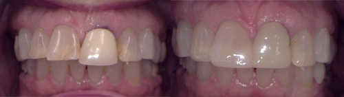 Dental Crowns before and after of J Henley