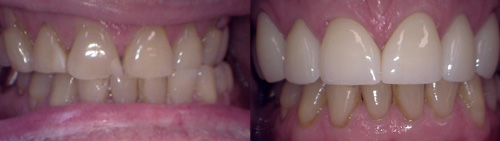 Before and after Dental Crowns of JT