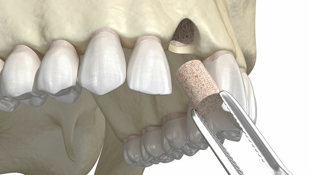 What You Need to Know About a Dental Bone Graft