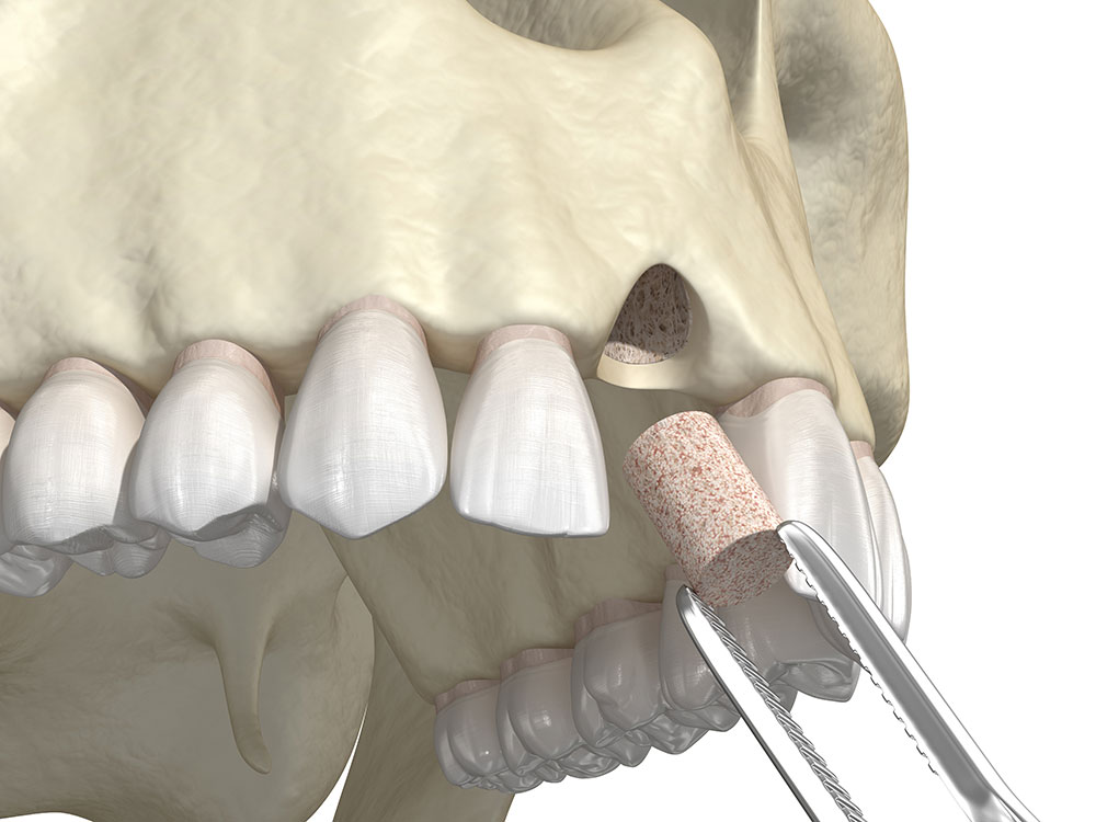 What You Need to Know About a Dental Bone Graft