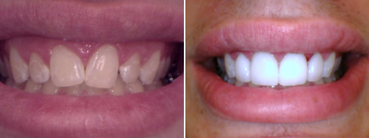 Veneers - Before and After