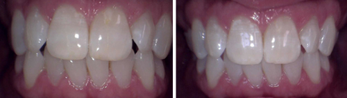Before and after teeth whitening of Dangel