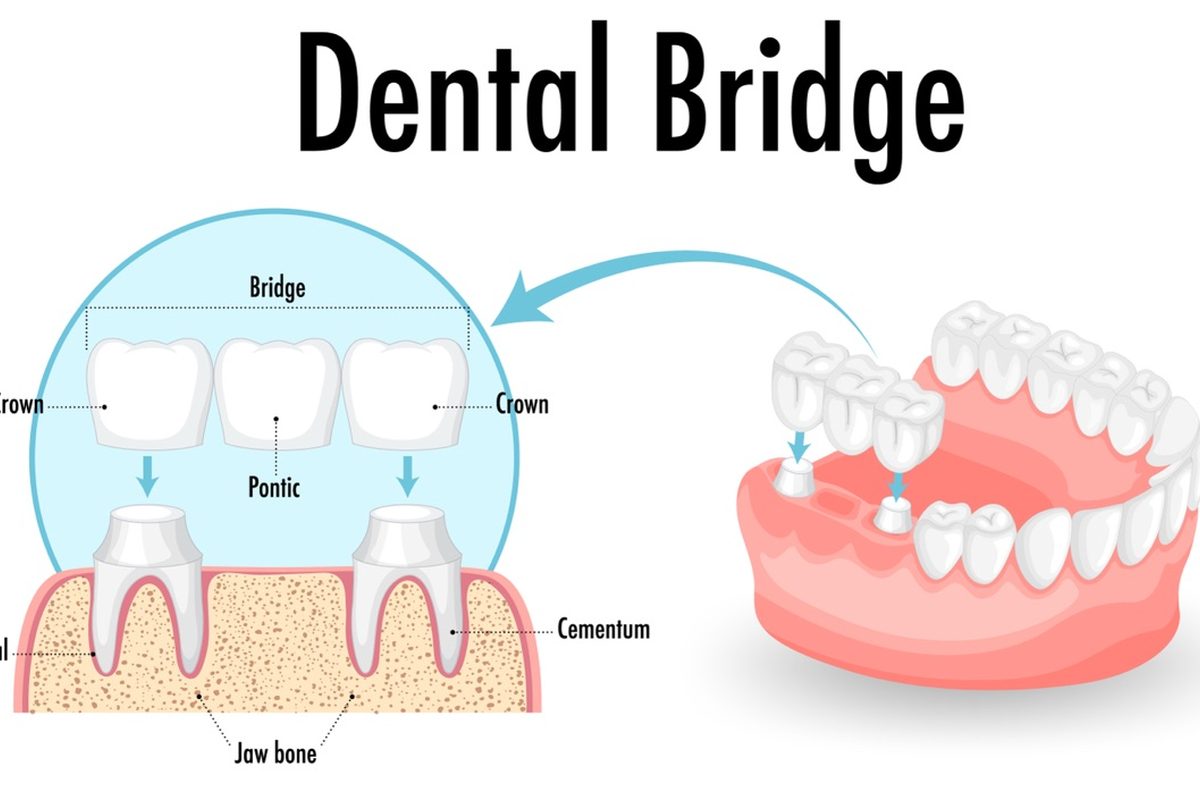 Dental bridge