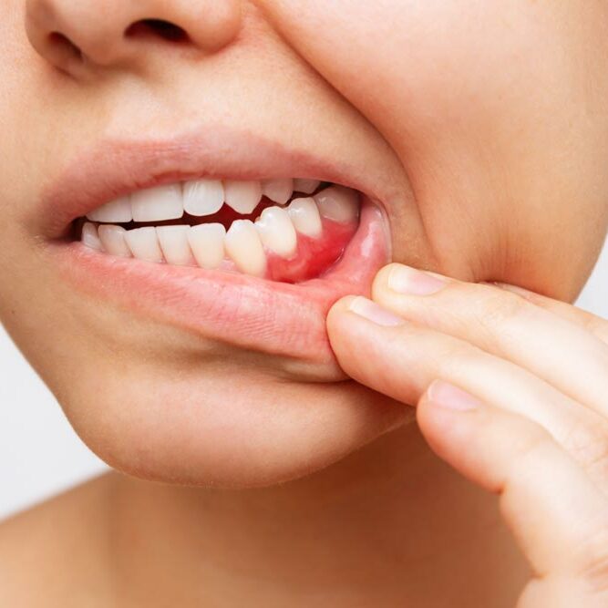 Can Gum Disease Be Cured?