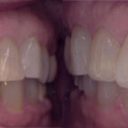 Dental Crowns before and after of J Henley