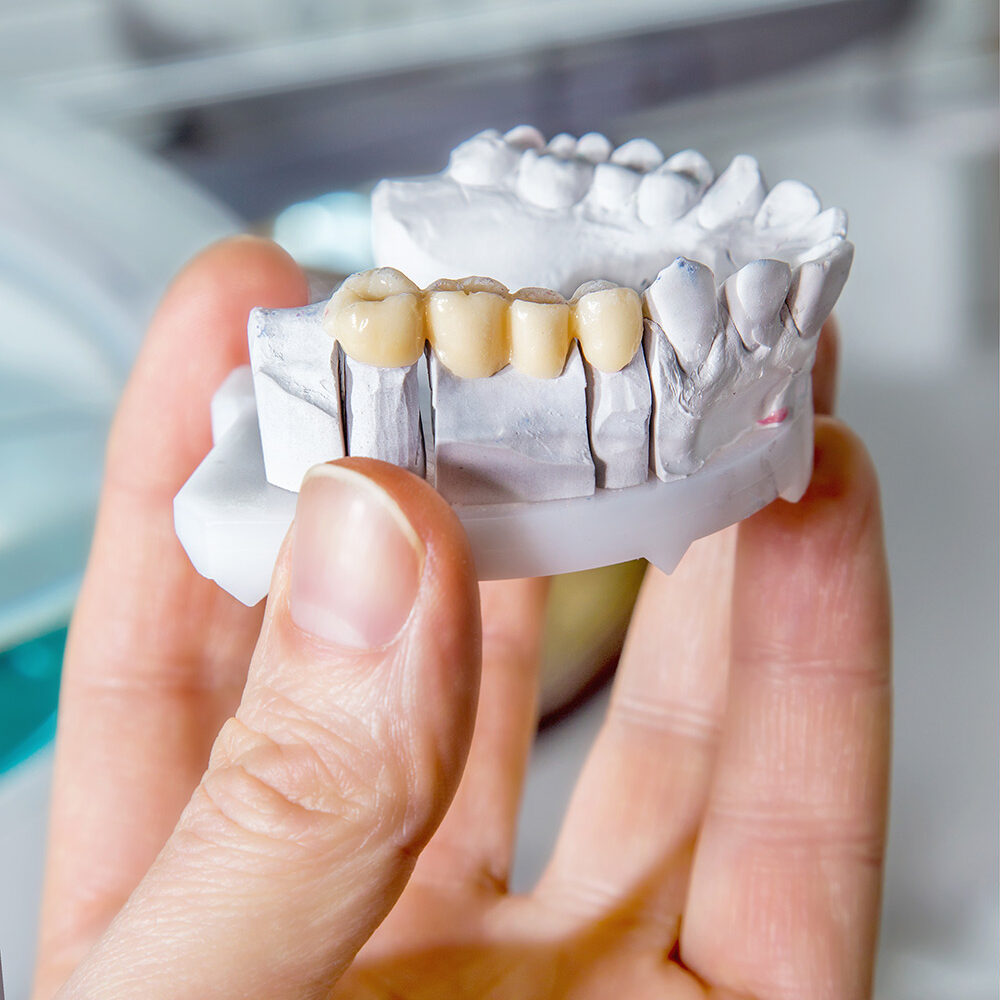 What Is a Dental Bridge?