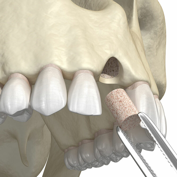 What You Need to Know About a Dental Bone Graft